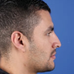 EXTRAORAL-LATERAL