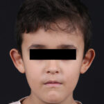 OTOPLASTIA FRONTAL