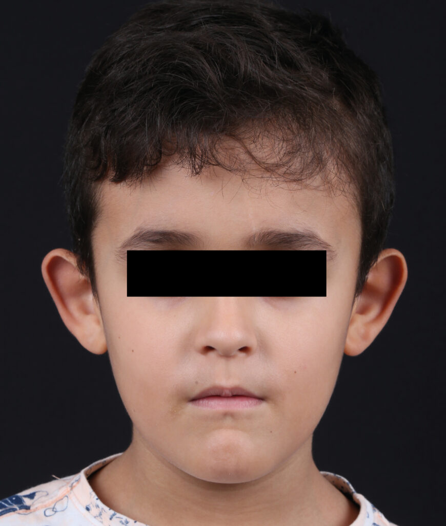 OTOPLASTIA FRONTAL