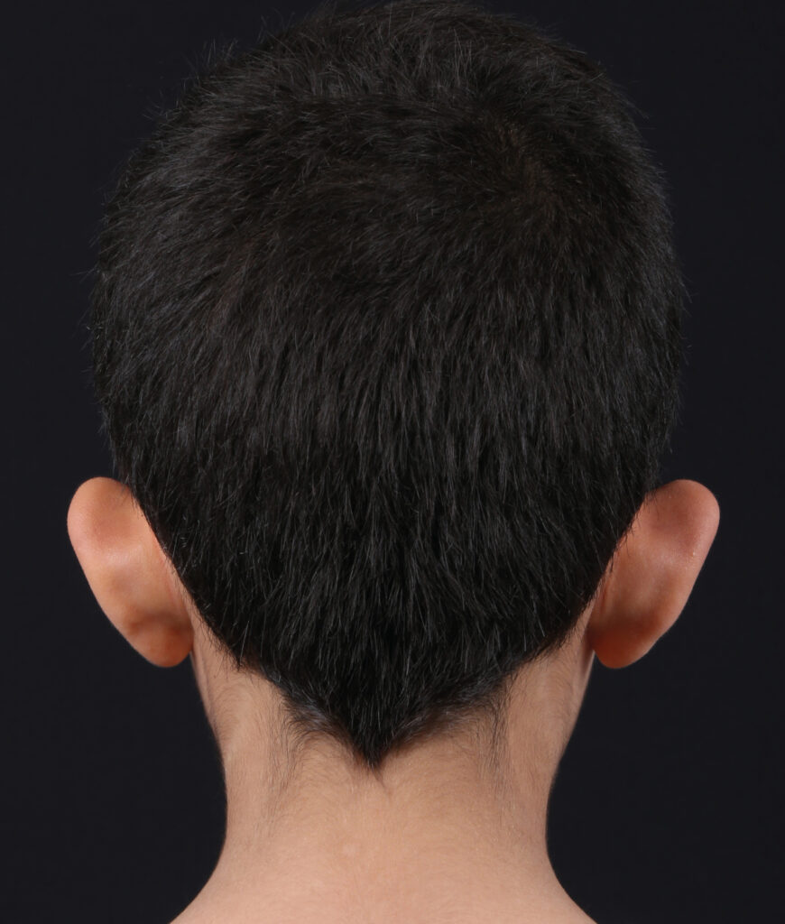 OTOPLASTIA POSTERIOR