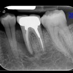 PERIAPICAL1