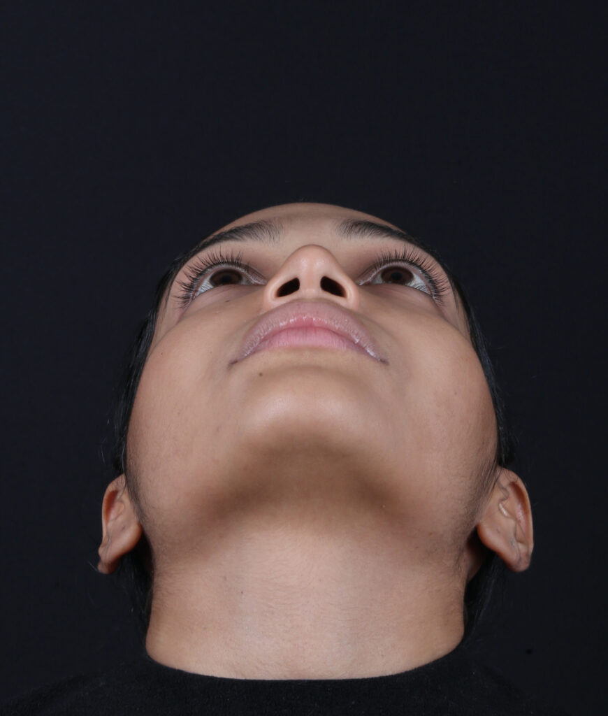 RINOPLASTIA BASE