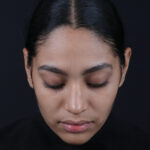 RINOPLASTIA CENITAL