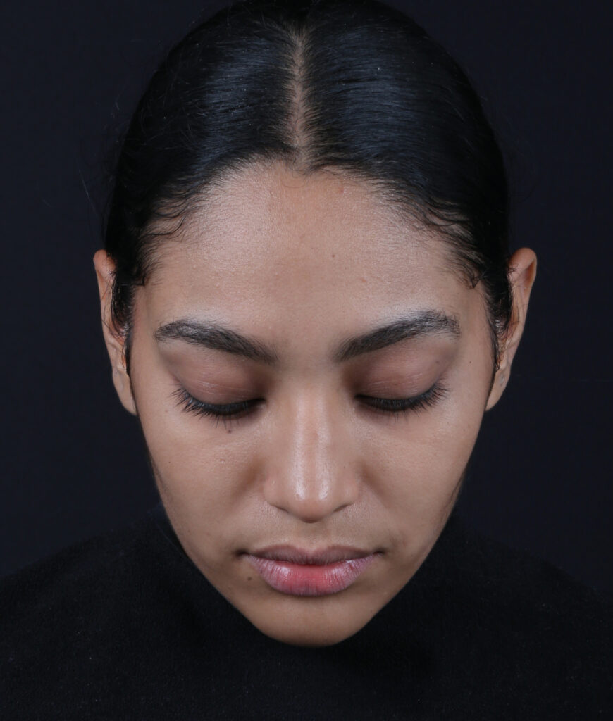 RINOPLASTIA CENITAL