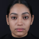 RINOPLASTIA FRONTAL
