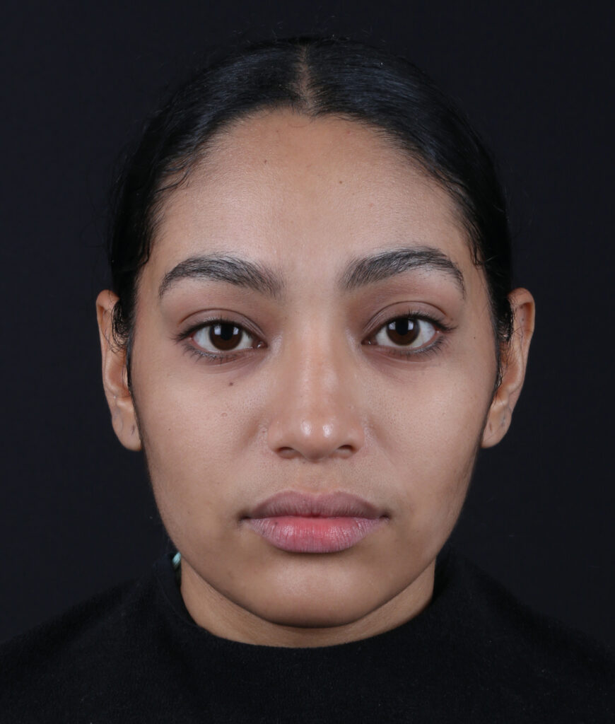 RINOPLASTIA FRONTAL