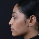 RINOPLASTIA LATERAL-