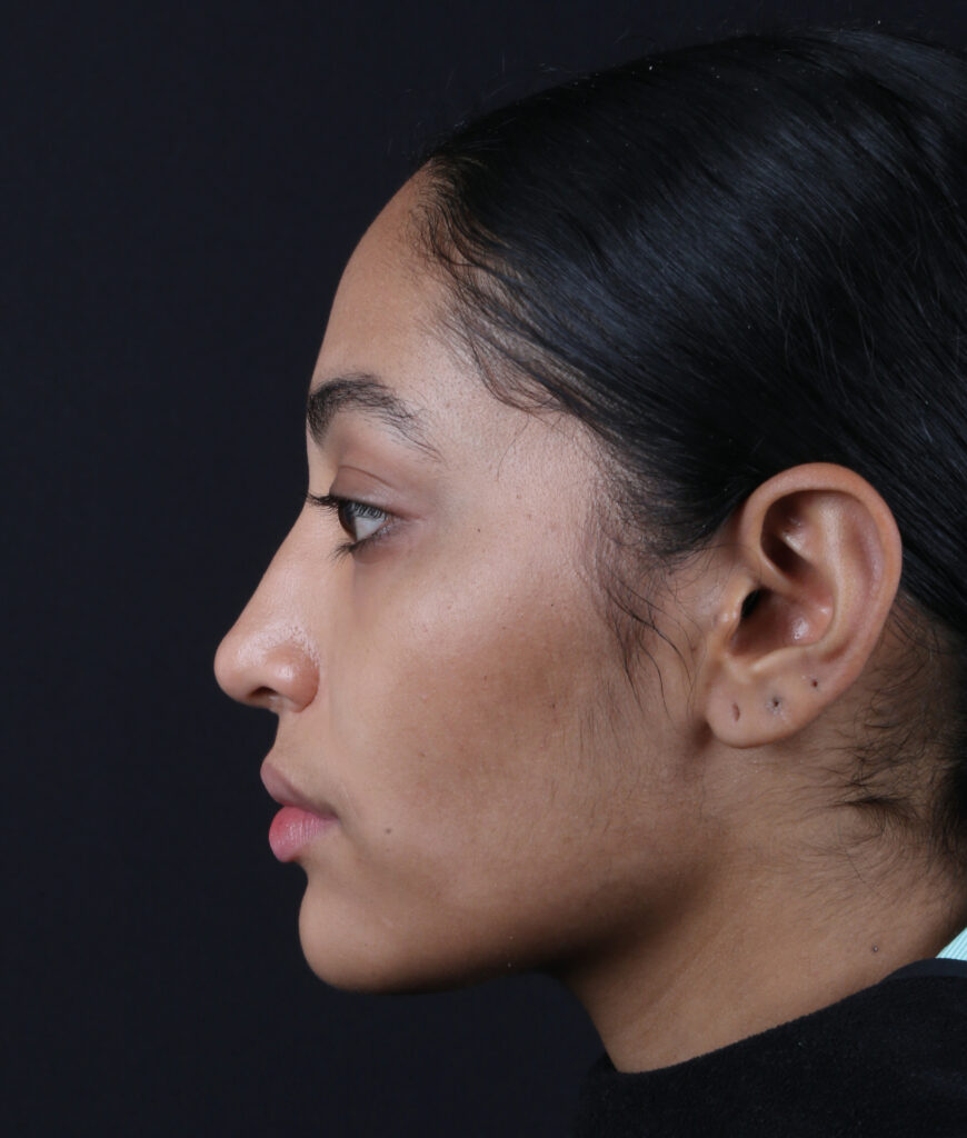 RINOPLASTIA LATERAL-