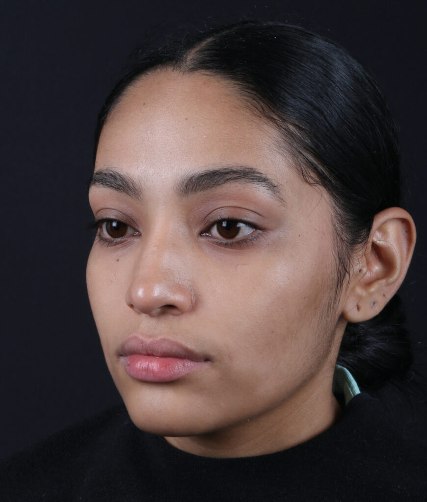RINOPLASTIA OBLICUO-