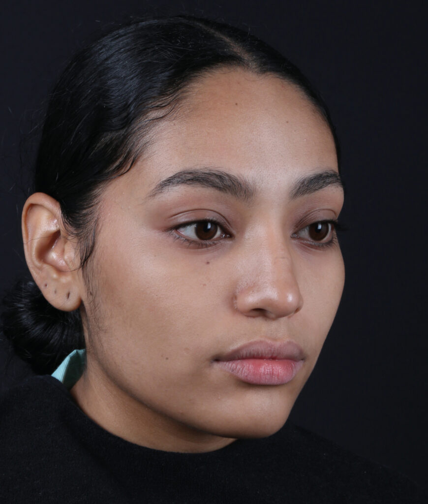 RINOPLASTIA OBLICUO