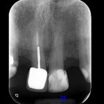 periapical