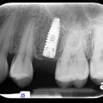 periapical2