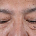 BLEFAROPLASTIA-ABAJO
