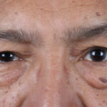 BLEFAROPLASTIA-ABIERTA