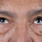 BLEFAROPLASTIA-ARRIBA