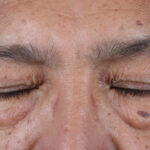 BLEFAROPLASTIA-CERRADOS