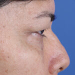 BLEFAROPLASTIA-CLOSE-UP