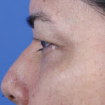 BLEFAROPLASTIA-CLOSE-UP1