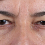 BLEFAROPLASTIA-CLOSE-UP2