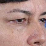 BLEFAROPLASTIA-CLOSE-UP3