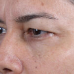 BLEFAROPLASTIA-CLOSE-UP4