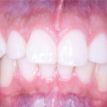 INTRAORAL