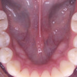 INTRAORAL4
